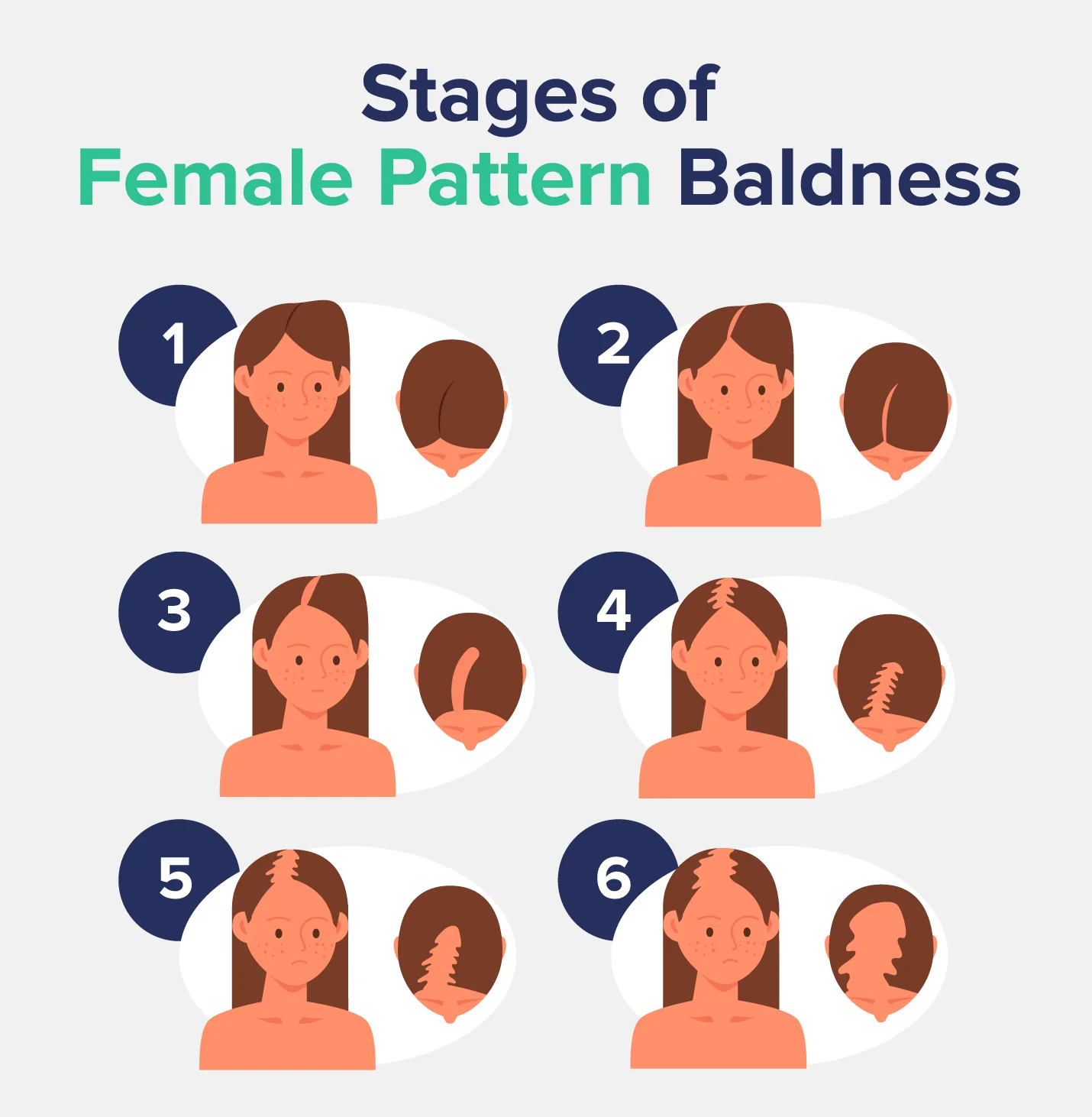 Stages of Female Pattern Baldness